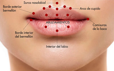 Ácido Hialurónico en Labios