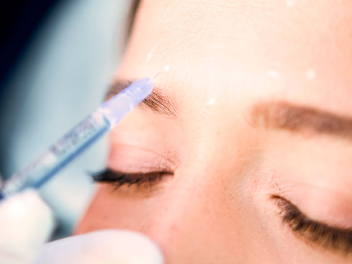 5 aplicaciones del botox que seguramente no conocías