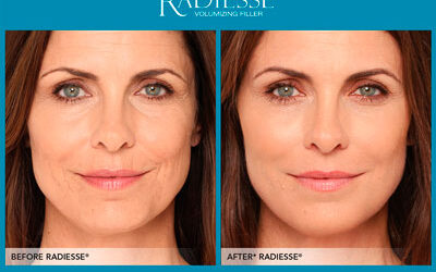 Sculptra y Radiesse ¿Son lo mismo?