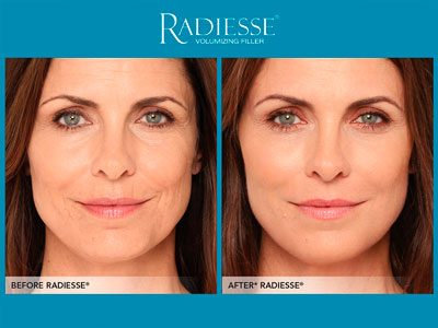 Sculptra y Radiesse ¿Son lo mismo?